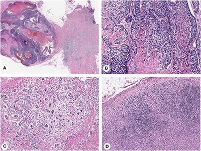 Tumor Heterogeneity in Breast Cancer